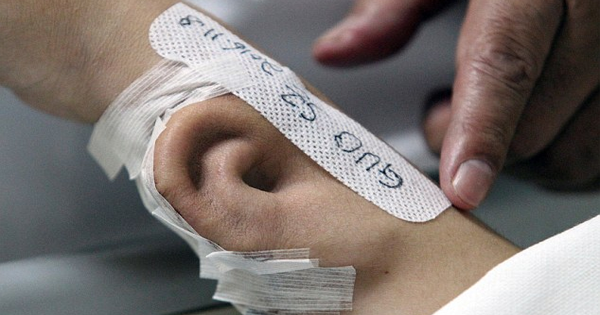 He Loses An Ear, So His Doctor Decides To Grow Him A New One On His Arm