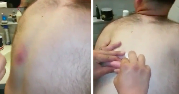 His Friend Tries Squeezing His Pimple. Moments Later, His Friend Screams In Horror. The Reason Why? It Exploded All Over Him.