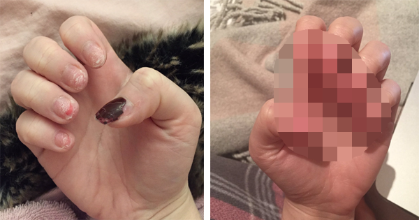 Wearing Acrylics Completely Destroys Her Natural Nails. But It