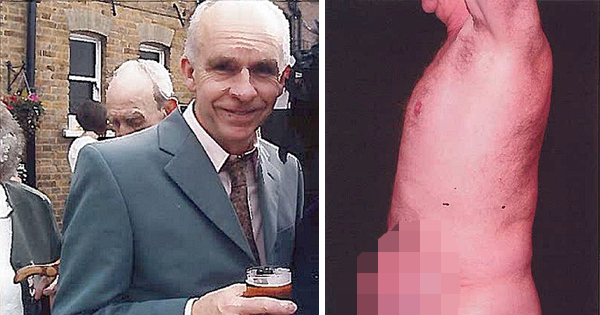 A Cancer Patient Undergoes Surgery To Remove His Tumor, But Only Ends Up Losing His Genitals