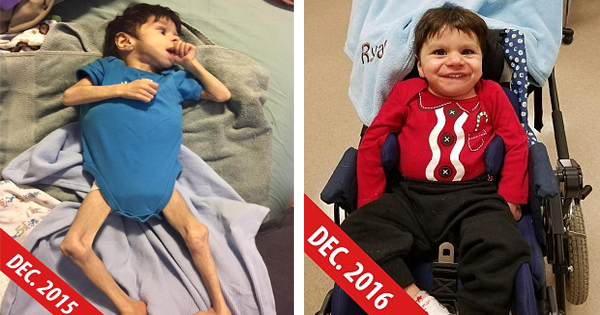 A Malnourished Orphan With Special Needs Gets A Second Chance To Live When He