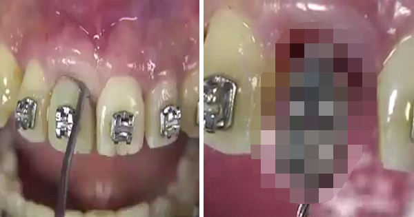 The Way This Patient Has His Front Tooth Removed Is Terrifying