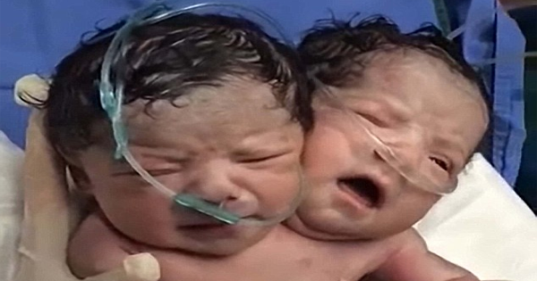 An Incredibly Rare Set Of Conjoined Twins Is Born In Mexico. Doctors Don