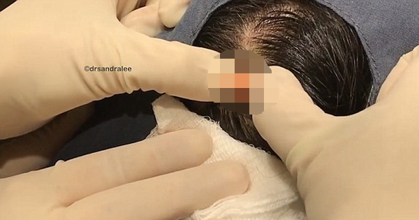 When He Gets His Cyst Removed, The Pus Literally Pops Out Of His Head As A Ball.
