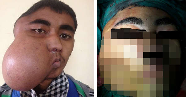 A Tumor On His Face Inhibits His Ability To Breathe For Over 10 Years. Now, Doctors Are Finally Giving Him A Chance To Have A Normal Life.