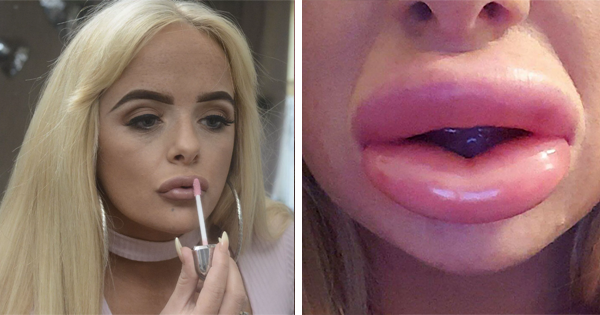 After Getting Cheap Lip Fillers, Her Lips Look Like Sausages Hanging Off Her Face.