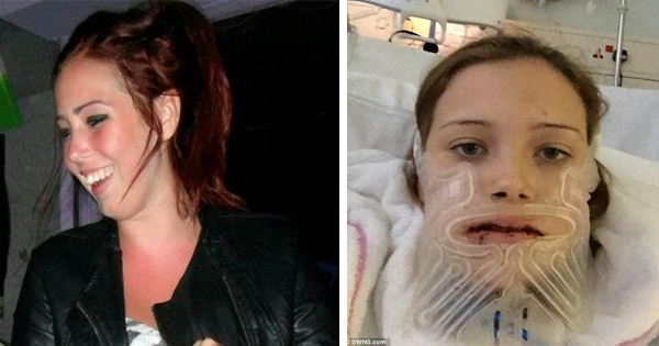 For Years, Her Protruding Jaw Would Detach Whenever She Yawned. See What She Looks Like After Doctors Install 4 Metal Plates And 50 Screws To Fix It.