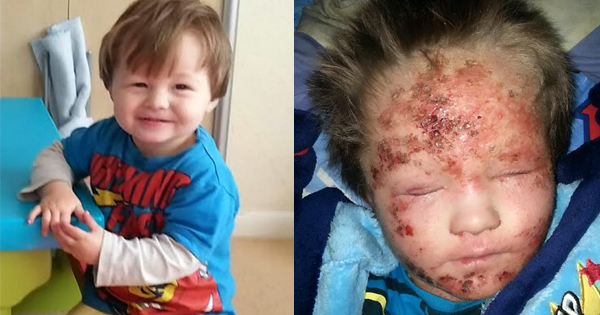 After Using Different Treatments, This Boy’s Eczema Keeps Getting Worse. That