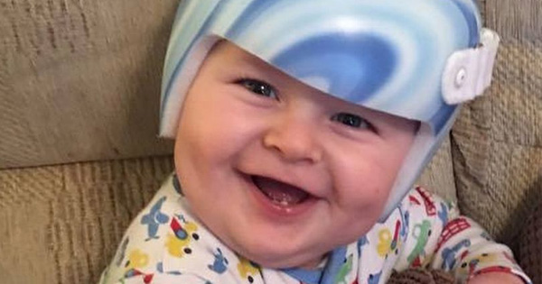 Her Baby Keeps Tilting His Head To One Side. Now, He Has To Wear A Special Helmet 23 Hours Every Day.
