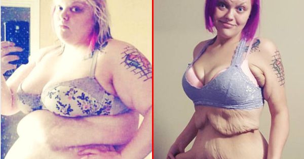 After Losing A Lot Of Weight, She Still Feels Fat Because Of The 