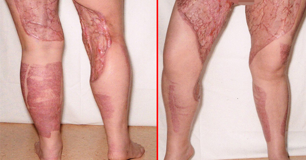 All She Wants Is To Shave Her Bikini Line. But, She Ends Up With A Flesh-Eating Bacteria.