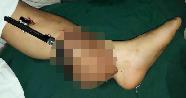 After Suffering From A Freak Accident, Doctors Attach His Severed Body Part In The Wrong Place.