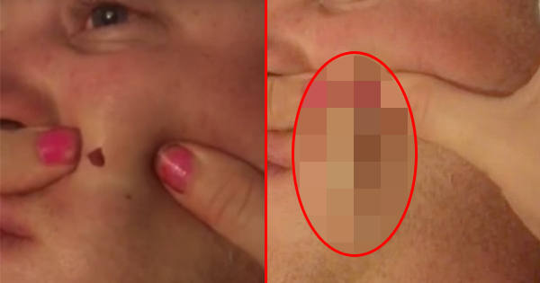 Wife Pops Husband’s Pimple That Has Been Growing For Four Years. She