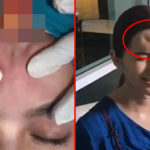 She Injects Filler Into Her Forehead To Remove Wrinkles. What She Gets Is A Big Painful Lump Instead.