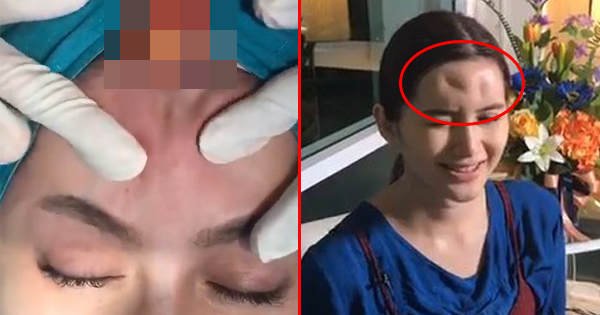 She Injects Filler Into Her Forehead To Remove Wrinkles. What She Gets Is A Big Painful Lump Instead.