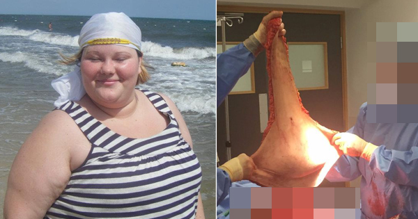 After Weighing 336 Pounds From Drinking Six Sodas A Day, She Goes Under The Knife To Make Herself Feel Better Again.