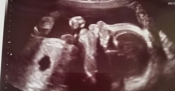 Doctors Spot A Frightening Black Hole On The Ultrasound, Then They Tell The Parents To 