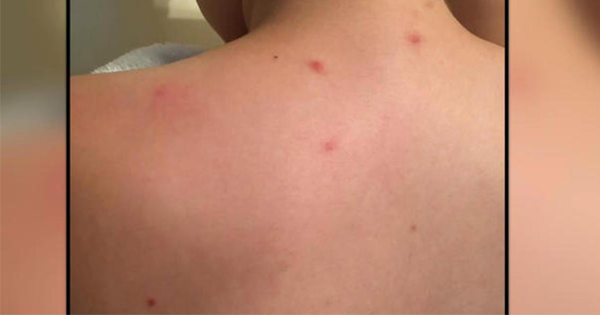 Kids Come Home From School With Weird Bites And Rashes, But Parents Don