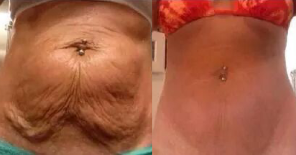 7 Natural Ways To Tighten Saggy Skin After Extreme Weight Loss
